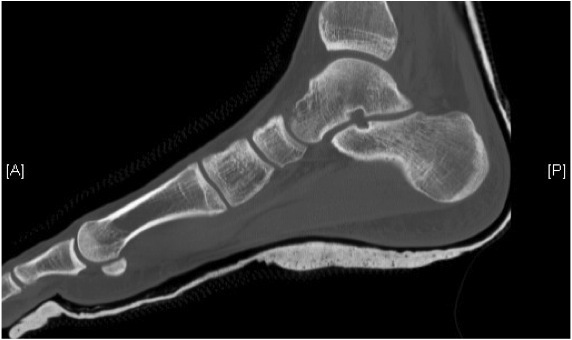 CT post subtalar dislocation 2